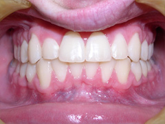 Dr. Ghilzon Orthodontics Case #1 - After