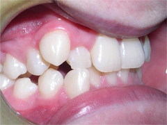 Dr. Ghilzon Orthodontics Case #1 - Before Side