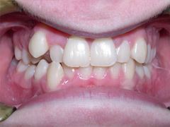 Dr. Ghilzon Orthodontics Case #1 - Before