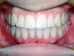 Dr. Ghilzon Orthodontics Case #2 - After