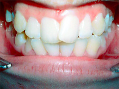 Dr. Ghilzon Orthodontics Case #2 - Before