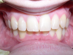 Dr. Ghilzon Orthodontics Case #3 - After