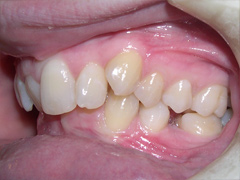 Dr. Ghilzon Orthodontics Case #3 - Before Side
