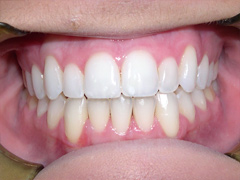 Dr. Ghilzon Orthodontics Case #4 - After