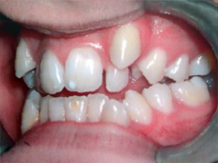 Dr. Ghilzon Orthodontics Case #4 - Before Side