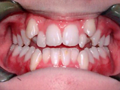 Dr. Ghilzon Orthodontics Case #4 - Before