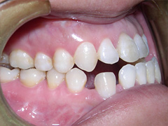 Dr. Ghilzon Orthodontics Case #5 - Before Side