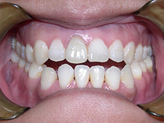 Dr. Ghilzon Orthodontics Case #5 - Before