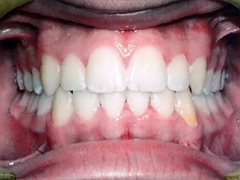 Dr. Ghilzon Orthodontics Case #6 - After