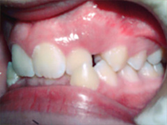 Dr. Ghilzon Orthodontics Case #6 - Before Side