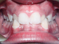 Dr. Ghilzon Orthodontics Case #6 - Before