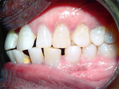 Dr. Ghilzon Orthodontics Case #7 - Before Side