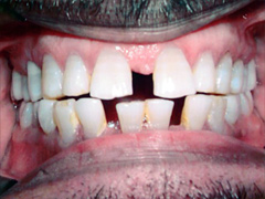 Dr. Ghilzon Orthodontics Case #7 - Before